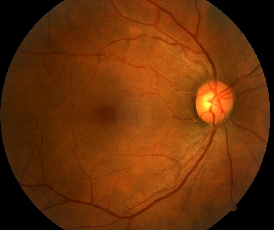 Retinografia
