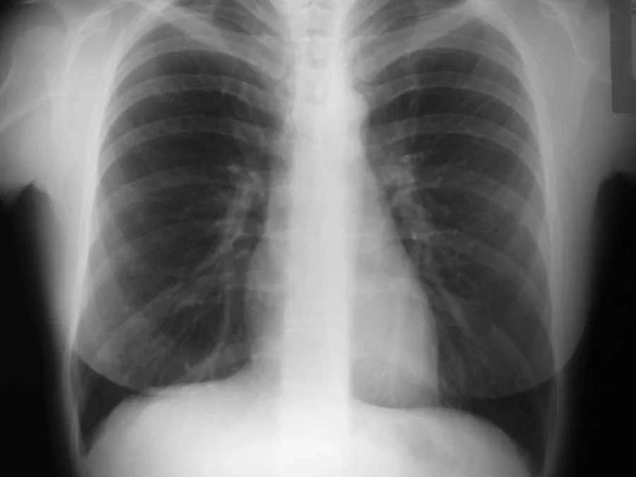 Radiografia de tórax